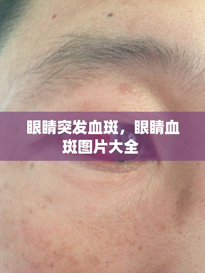 眼睛突发血斑,眼睛血斑图片大全